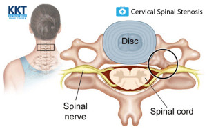 Signs and Symptoms Cervical Spinal Stenosis Signs and Symptoms Cervical Spinal Stenosis