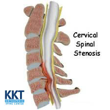 cervical stenosis