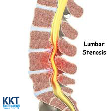 lumbar spinal stenosis