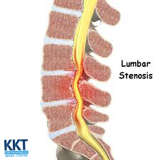 lumbar spinal stenosis lumbar spinal stenosis