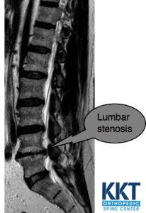 Signs and Symptoms of lumbar spinal stenosis