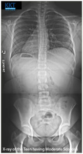 Symptoms of Adult Scoliosis