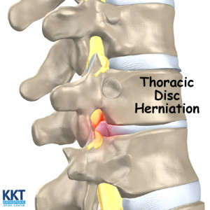 Thoracic Disc Herniation Thoracic Disc Herniation