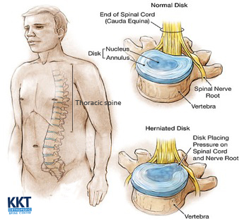 Symptoms of Thoracic Disc Herniation Symptoms of Thoracic Disc Herniation