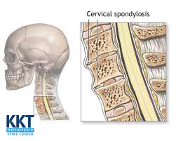Spondylosis or Spinal Degeneration