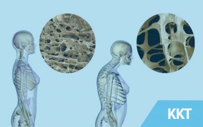 How to live with and manage with osteoporosis