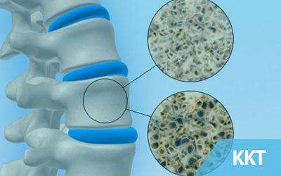 Osteoporosis – Who Is At Risk?