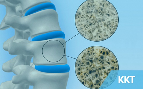 Osteoporosis – Who Is At Risk?