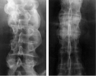 Neck Pain Reasons Ankylosing Spondylitis