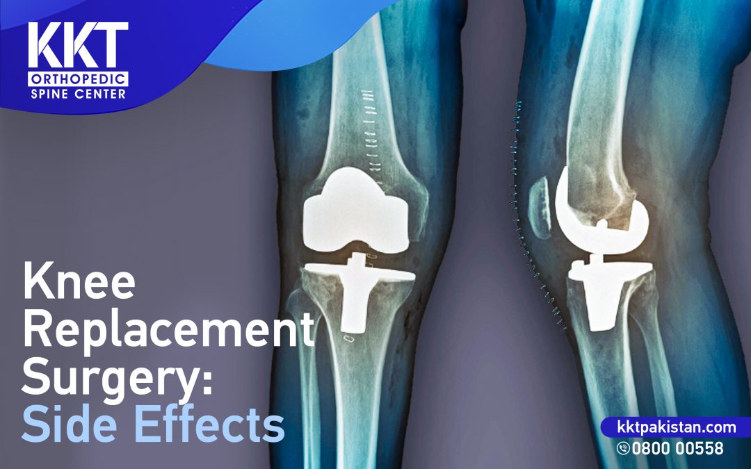 Knee Replacement Surgery: Side Effects