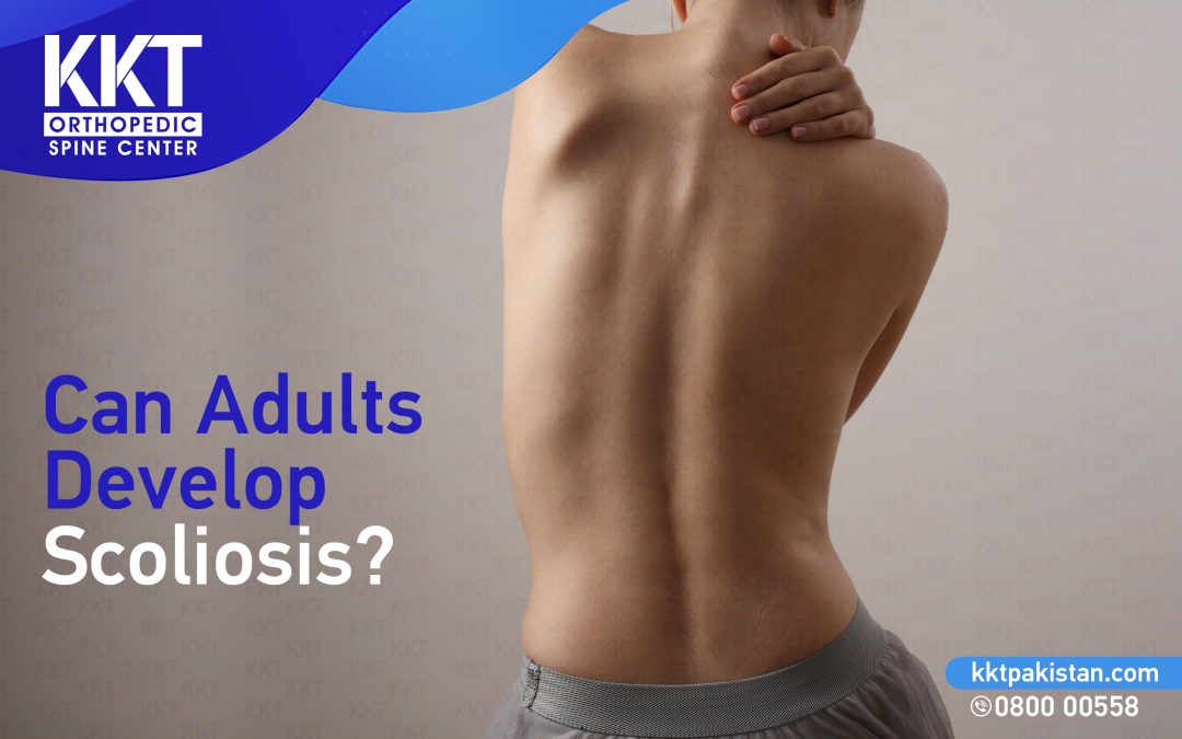 Can adults develop Scoliosis?