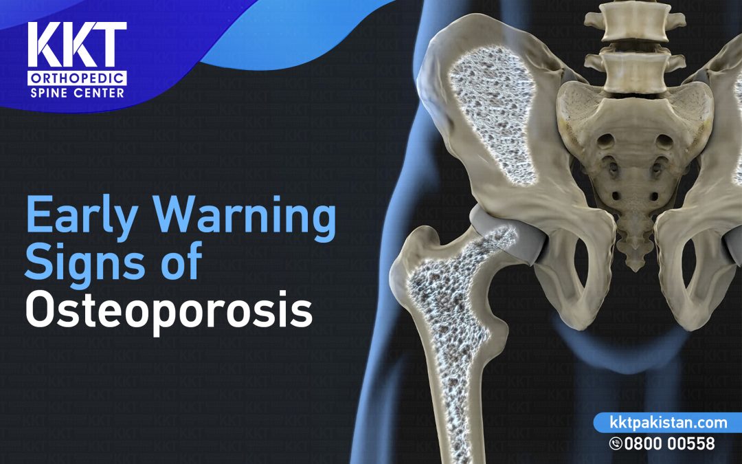 Early warning signs of Osteoporosis